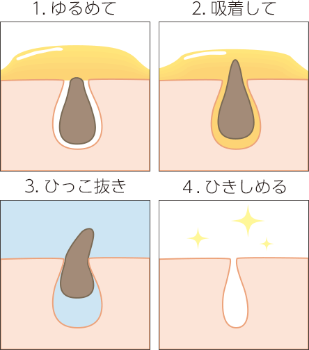 1.ゆるめて2.吸着して3.ひっこ抜き4.ひきしめる