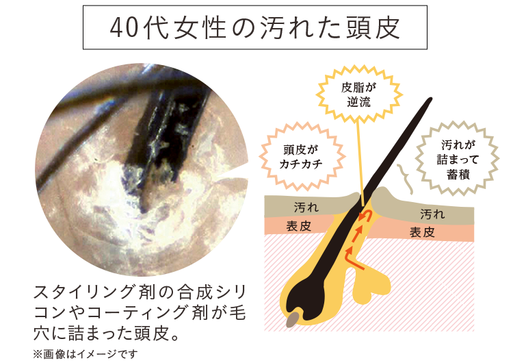 40代女性の汚れた頭皮。スタイリング剤の合成シリコンやコーティング剤が毛穴に詰まった頭皮。